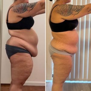 Recomp Clinic 1:1 coaching client before and after body transformation